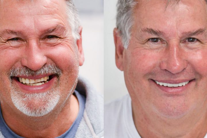 Teeth on Implants Before & After