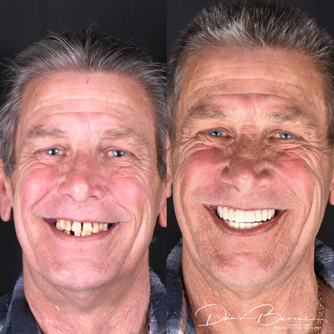 Teeth on Implants