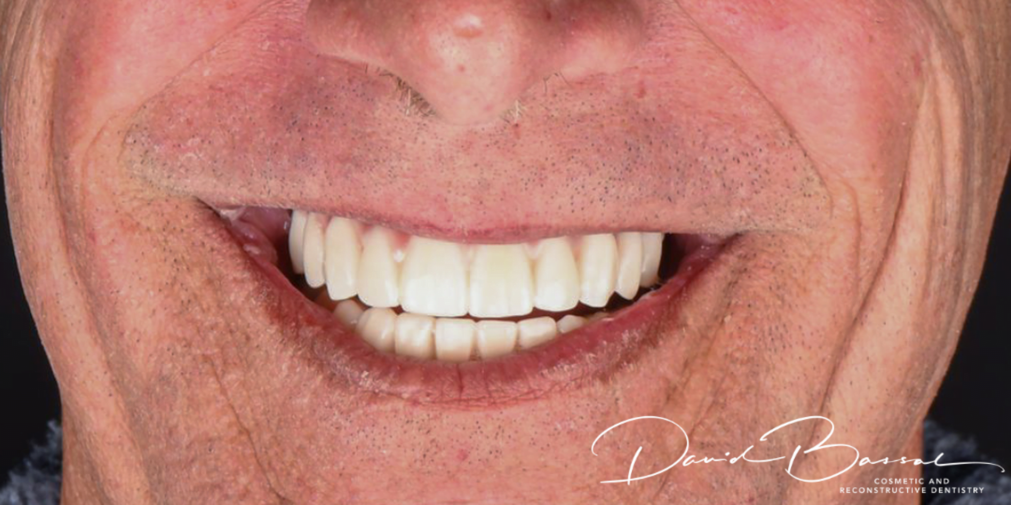 Teeth on Implants - Poynton Place Dental Implants